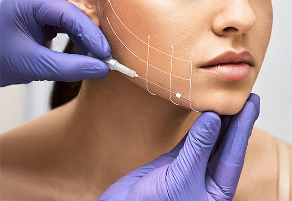 Rhytidectomy facelift procedure