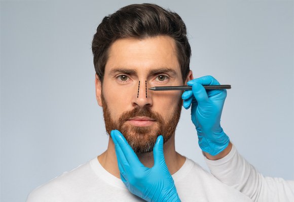 Rhinoplasty procedure