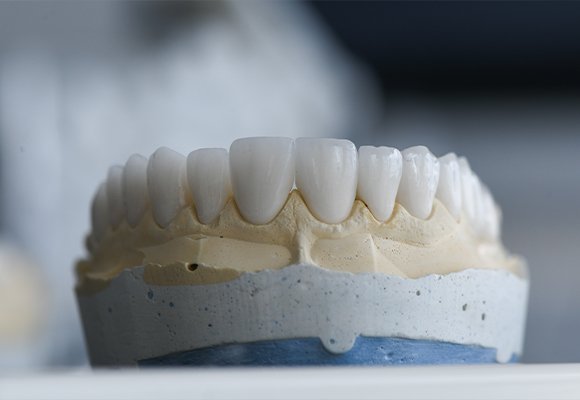 Crown And Bridge — Crown and Bridge | Ruby Hall Clinic
