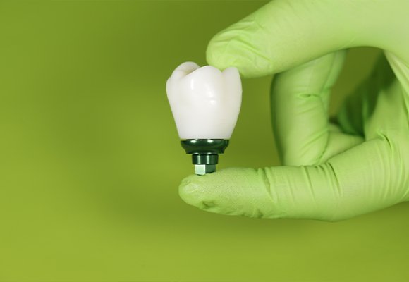 Dental Implants — Dental Implants | Ruby Hall Clinic