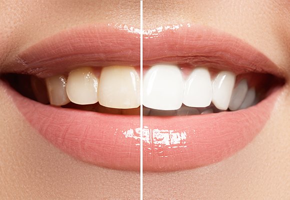 Tooth Bleaching — Tooth Bleaching | Ruby Hall Clinic