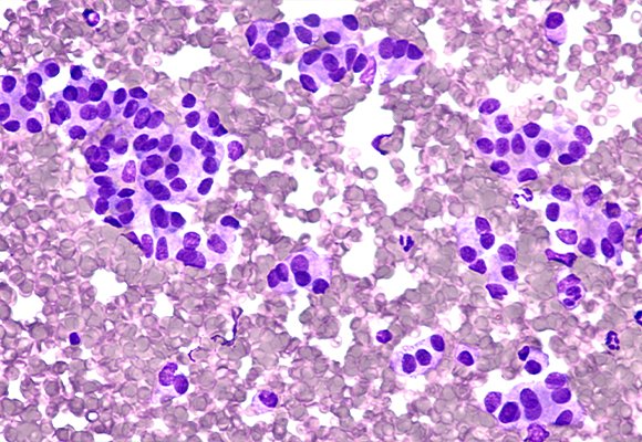 Endobronchial Ultrasound (EBUS)